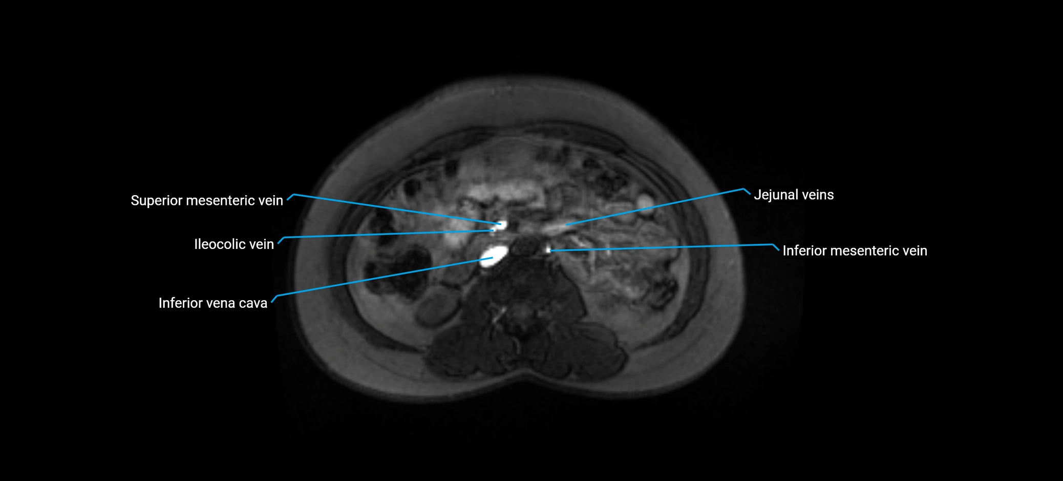 MRV abdomen pelvis & lower limb axial cross sectional anatomy labelled MRI image 84 (1).webp